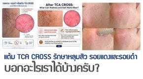 แต้ม TCA CROSS รักษาหลุมสิว รอยแดงและรอยดำ บอกอะไรเราได้บ้างครับ?